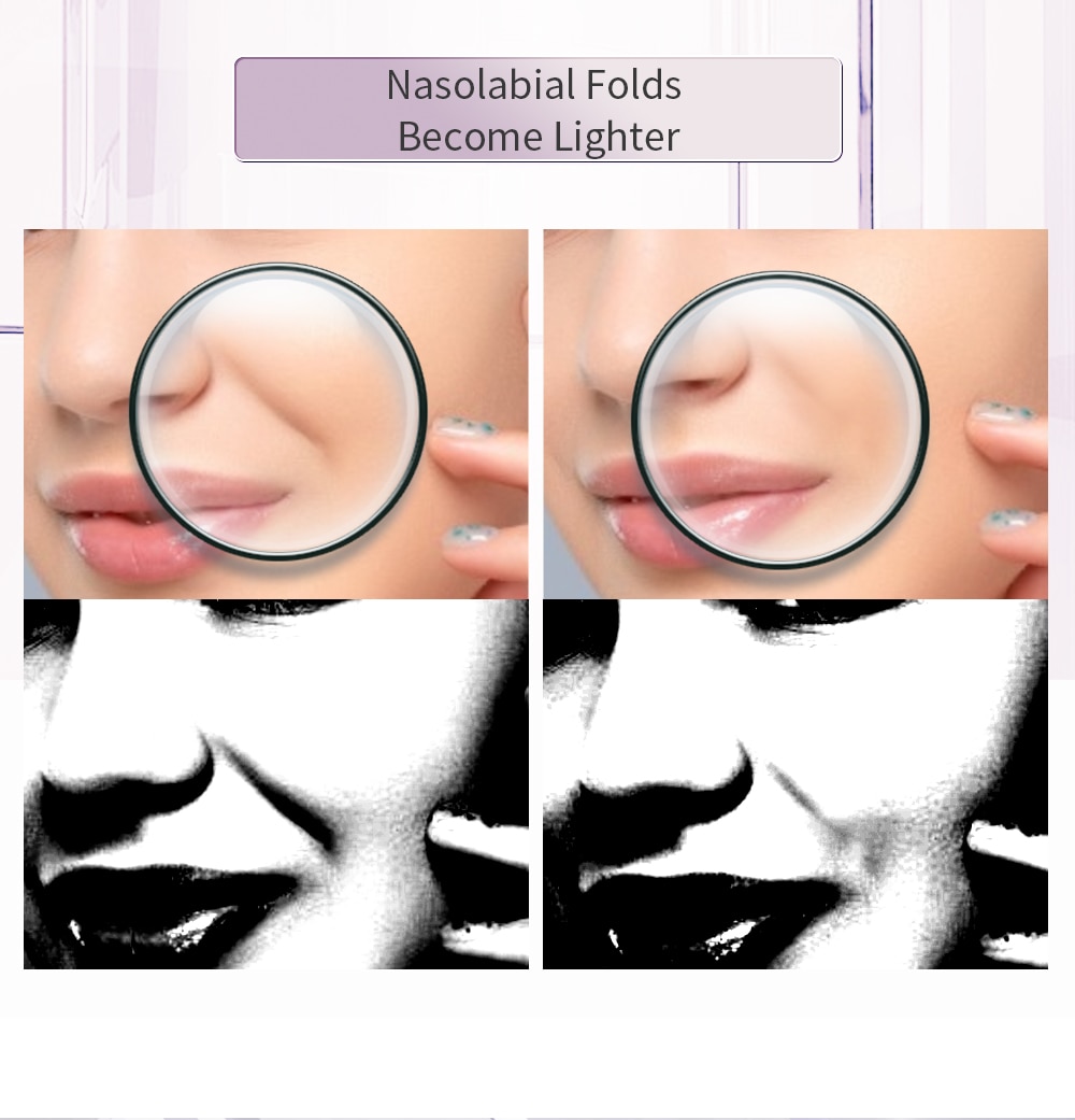 Radiofrequency Face Lifting Beauty Device
